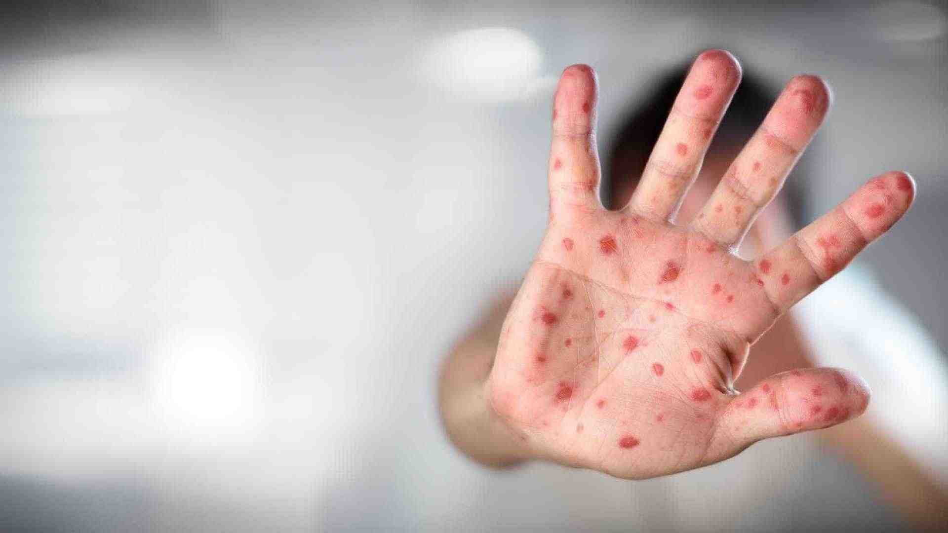 Fevereiro terá nova campanha de vacinação contra o sarampo